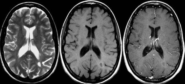 Coupe axiale d'un cerveau humain avec 3 pondérations différentes. De gauche à droite : pondération T1, pondération T2 avec produit de contraste et pondération T2 sans produit de contraste.
